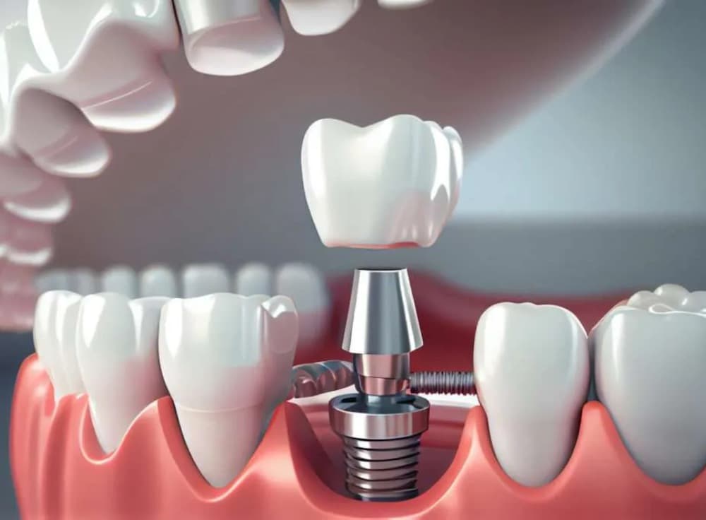Dental Implant