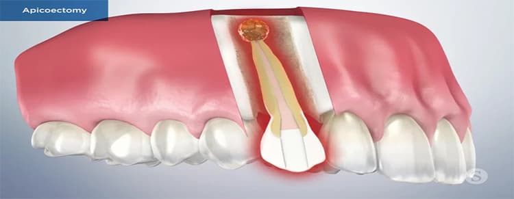 Apicoectomy Surgery