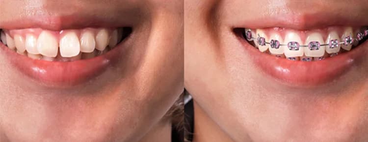 Correction of Gaps/Spaces Between Teeth