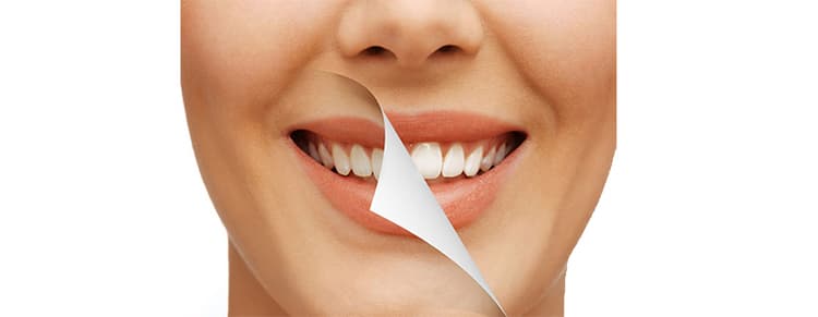 Cosmetic Intraoral Surgery