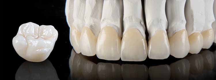 Crown/Capping & Fixed Bridge Works (Metal, PFM, Full Ceramic)