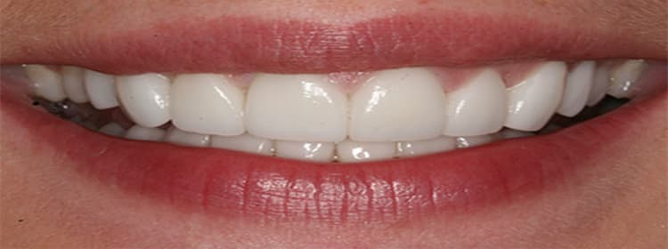 Dental Veneer & Thinner
