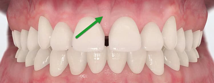 Frenectomy & Frenuloplasty