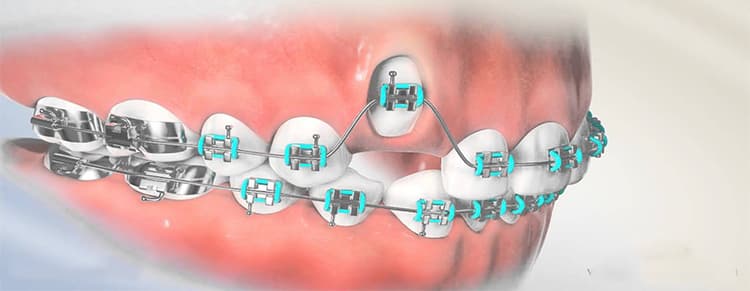 Surgical Exposure of Impacted/Timely Non-Erupted Front Tooth/Teeth