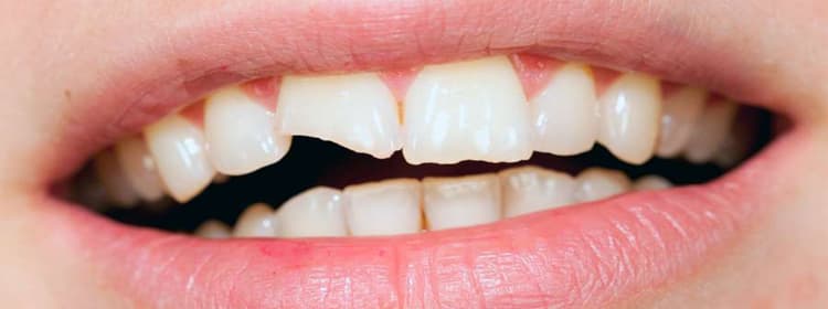 Treatment of Fractured, Broken Tooth