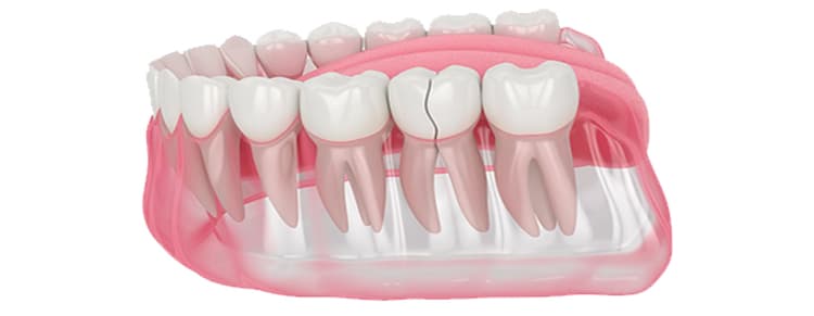 Treatment of Fractured, Broken Tooth
