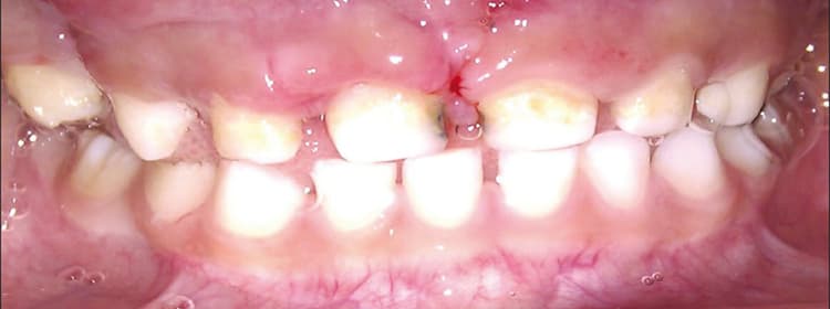 Tumor, Cyst Surgery & Treatment Of Jaw Fracture