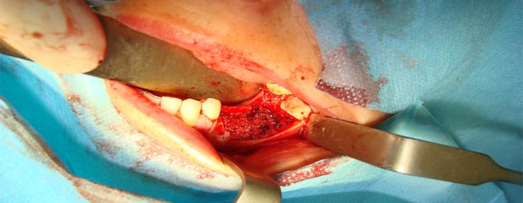 Tumor, Cyst Surgery & Treatment Of Jaw Fracture