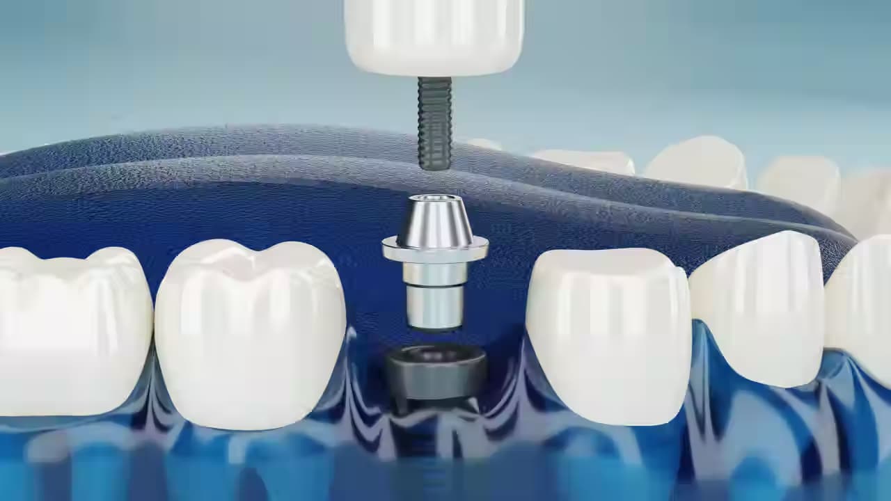Single vs. Multiple Dental Implants – Which is Right for You?