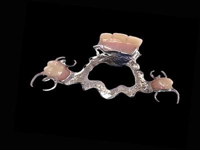 CAST PARTIAL DENTURE TREATMENT AT DENTITY DENTAL IN KOLKATA