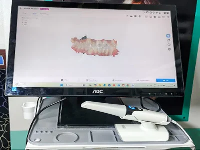 USE OF 3D ORAL SCANNER BEFORE CLEAR ALIGNER TREATMENT AT DENTITY DENTAL IN KOLKATA