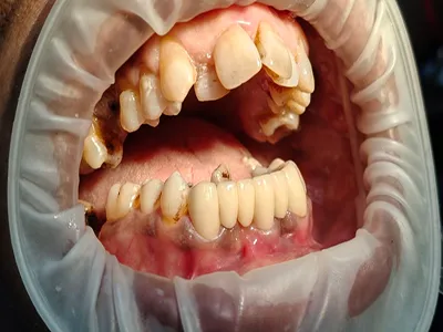 LOWER FRONT ZIRCONIA DENTAL BRIDGE AT DENTITY DENTAL IN KOLKATA