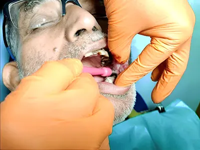 ORAL AND MAXILLOFACIAL BIOPSY TREATMENT AT DENTITY DENTAL IN KOLKATA