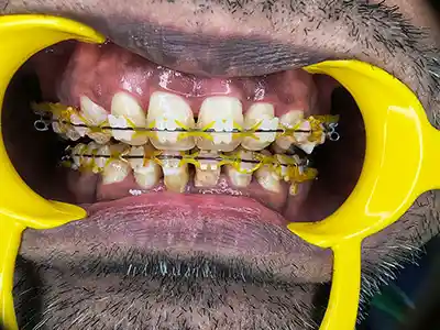 ORTHODONTIC TREATMENT WITH BRACKETS AT DENTITY DENTAL IN KOLKATA