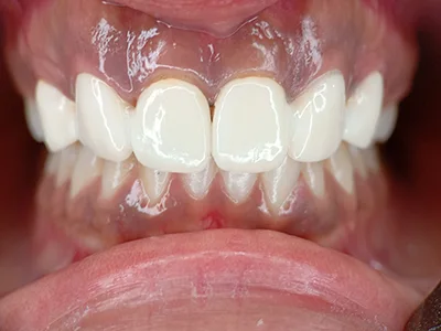 SMILE MAKEOVER TREATMENT AT DENTITY DENTAL IN KOLKATA