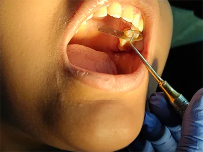 TEETH FILLING AND CAVITY TREATMENT AT DENTITY DENTAL IN KOLKATA