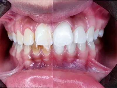 TEETH CLEANING AND SCALING AT DENTITY DENTAL IN KOLKATA