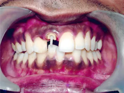 BEST FIBRE POST TREATMENT AT DENTITY DENTAL GARIAHAT AT GARIAHAT IN KOLKATA