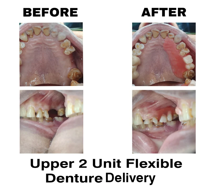 UPPER 2 UNIT FLEXIBLE DENTURE DELIVERY AT DENTITY DENTAL GARIAHAT