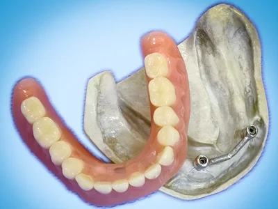 BEST DENTAL IMPLANT SUPPORTED OVERDENTURE AT DENTITY DENTAL GARIAHAT AT GARIAHAT IN KOLKATA