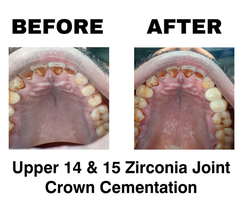 UPPER 14 AND 15 ZIRCONIA JOINT CROWN CEMENTATION AT DENTITY DENTAL GARIAHAT