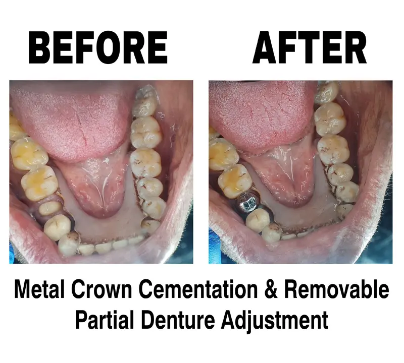 METAL CROWN CEMENTATION AND REMOVABLE PARTIAL DENTURE ADJUSTMENT AT DENTITY DENTAL GARIAHAT