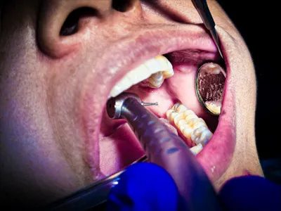 Cavity preparation for dental filling/restoration at Dentity Dental Rajarhat Teghoria NewTown in Rajarhat, Kolkata
