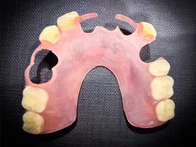 Maxillary flexible partial denture treatment at Dentity Dental Dum Dum Cantonment