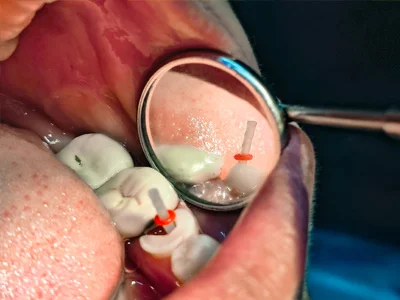 Post Core treatment of RCT-treated tooth at Dentity Dental Beleghata