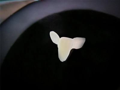 Maryland Bridge at Dentity Dental Teghoria