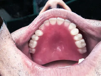 Complete denture treatment at Dentity Dental Rajarhat Teghoria NewTown in Rajarhat, Kolkata