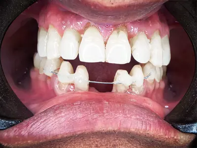 Splinted lower anterior periodontally weak teeth to give support and strength at Dentity Dental Sonarpur in Sonarpur, Kolkata