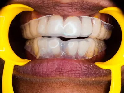 Bite guard ( soft)/ night guard for TMJ treatment at Dentity Dental Dum Dum Cantonment