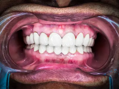 Smile Makeover and Full Mouth Rehabilitation to enhance the looks and functions of teeth at Dentity Dental Sonarpur in Sonarpur, Kolkata