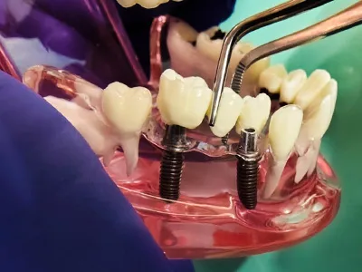 Dental implant-supported FPD for missing tooth replacement at Dentity Dental Beleghata