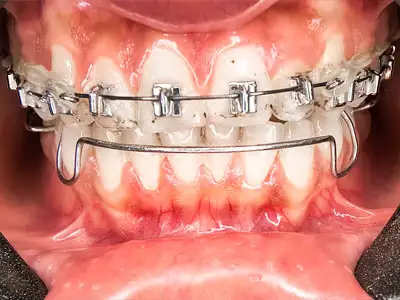 Fixed orthodontic braces and removable orthodontic appliance for teeth alignment treatment at Dentity Dental Tollygunge Netaji Nagar