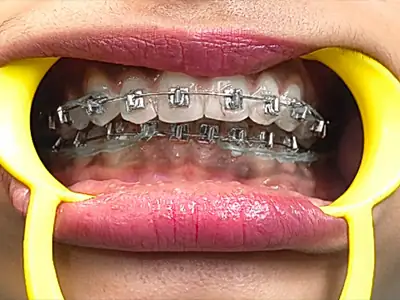 Teeth alignment by orthodontic braces at Dentity Dental Beleghata