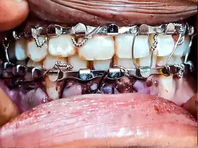 IMF to treat jaw fracture at Dentity Dental Tollygunge Netaji Nagar