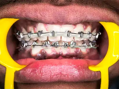 Dental braces treatment to correct malaligned teeth at Dentity Dental Teghoria