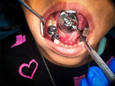 SS Peado Crown treatment after pulpectomy of child patient at Dentity Dental Teghoria