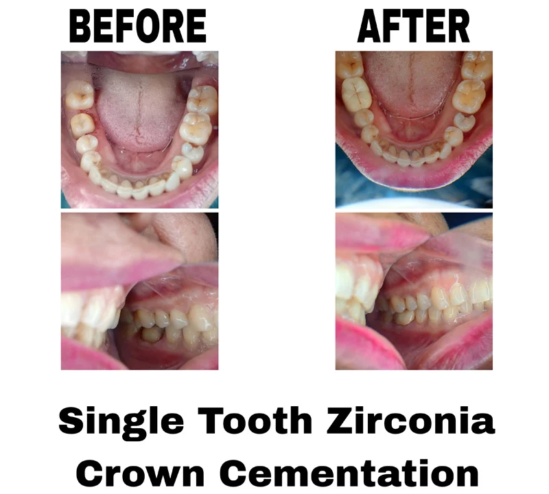 before-and-after-iamge-of-single-tooth-zirconia-crown-cementation-treatment-at-dentity-dental-beleghata