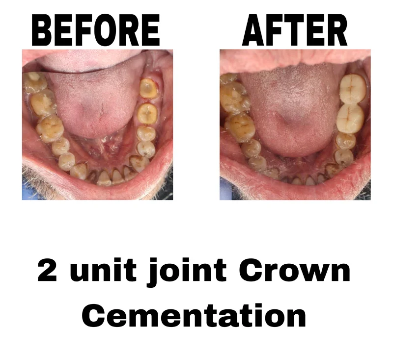 before-and-after-image-of-2-unit-joint-crown-cementation-treatment-at-dentity-dental-sonarpur
