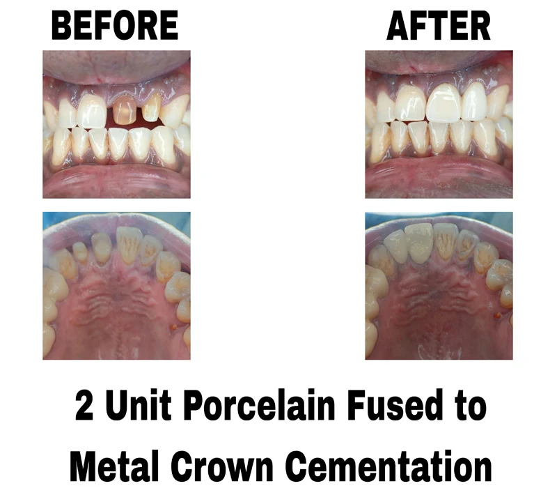 before-and-after-image-of-2-unit-porcelain-fused-to-metal-crown-cementation-treatment-at-dentity-dental-tollygunge-netaji-nagar