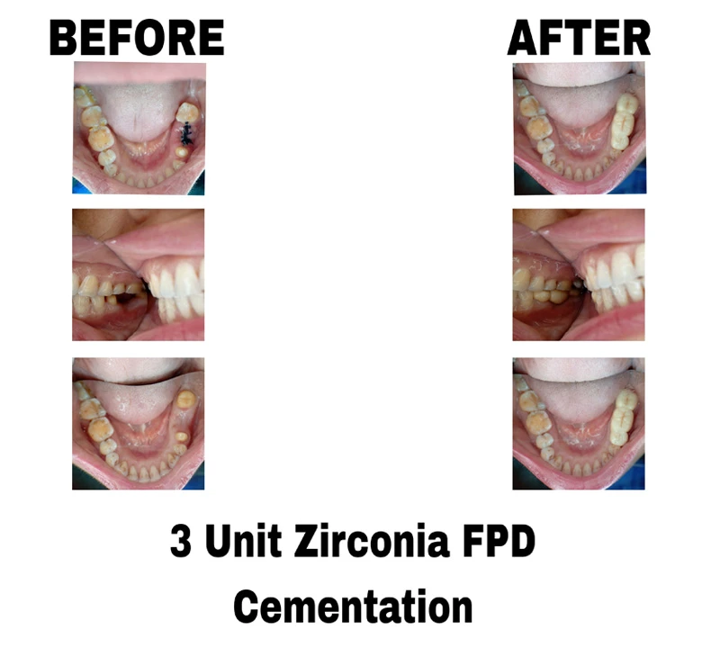 before-and-after-image-of-3-unit-zirconia-fpd-cementation-treatment-at-dentity-dental-dum-dum-cantonment