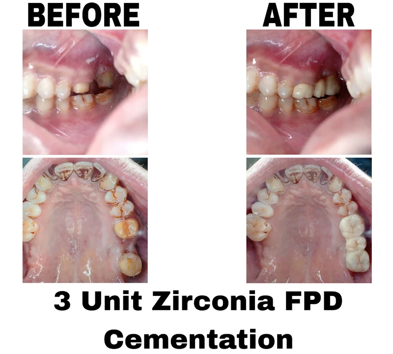 before-and-after-image-of-3-unit-zirconia-fpd-cementation-at-dentity-dental-teghoria