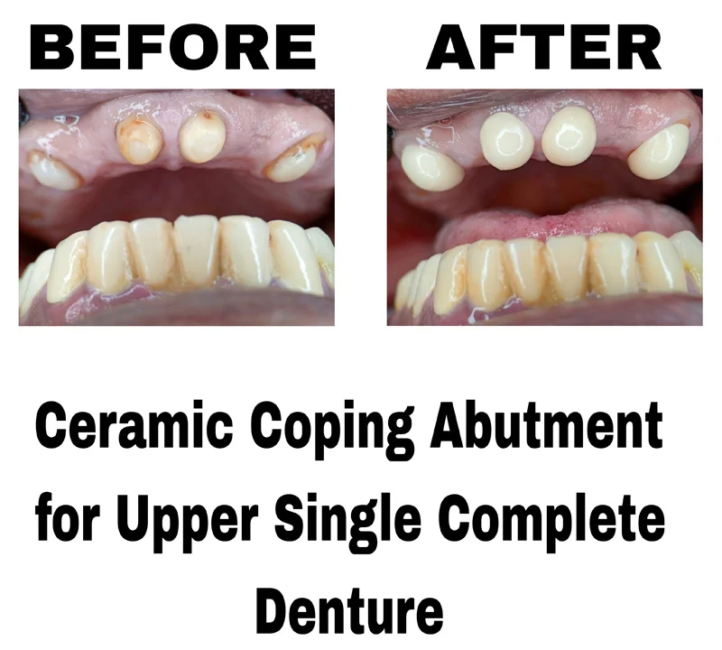 before-and-after-image-of-ceramic-coping-abutment-for-upper-single-complete-denture-at-dentity-dental-teghoria