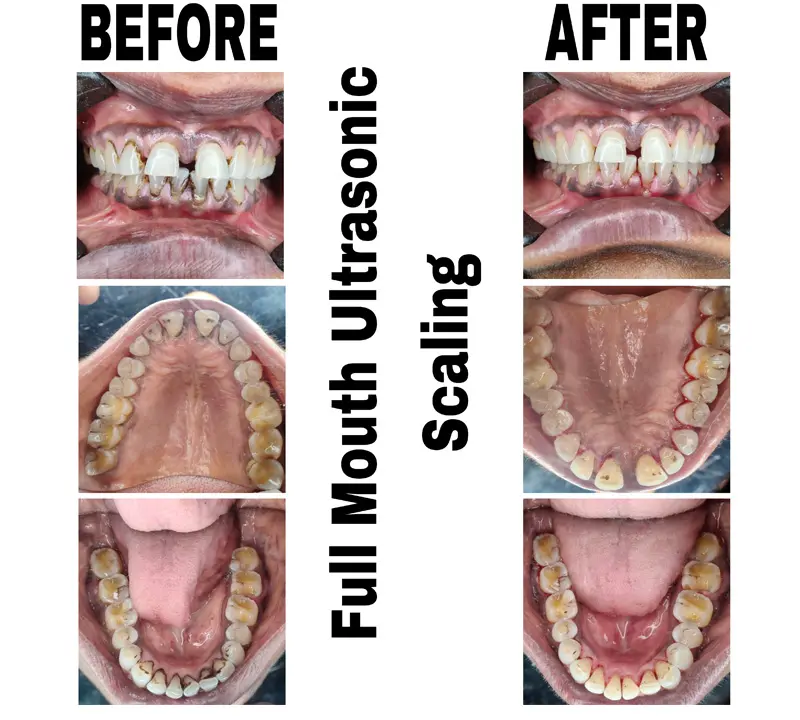 before-and-after-image-of-full-mouth-ultrasonic-scaling-treatment-at-dentity-dental-dum-dum-cantonment