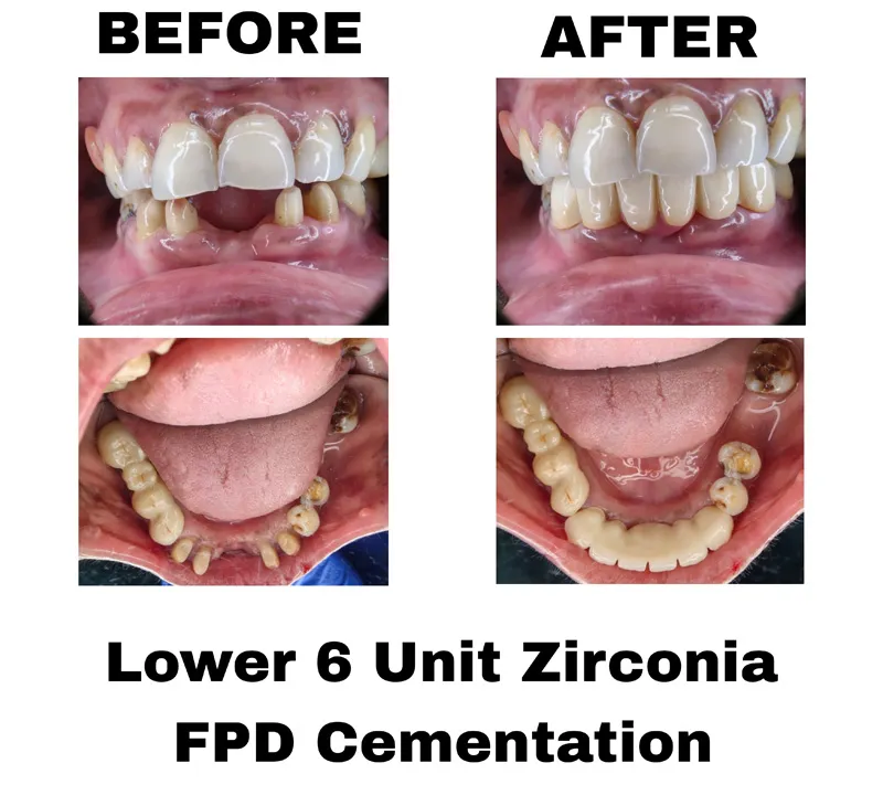 before-and-after-image-of-lower-6-unit-zirconia-fpd-cementation-treatment-at-dentity-dental-tollygunge-netaji-nagar