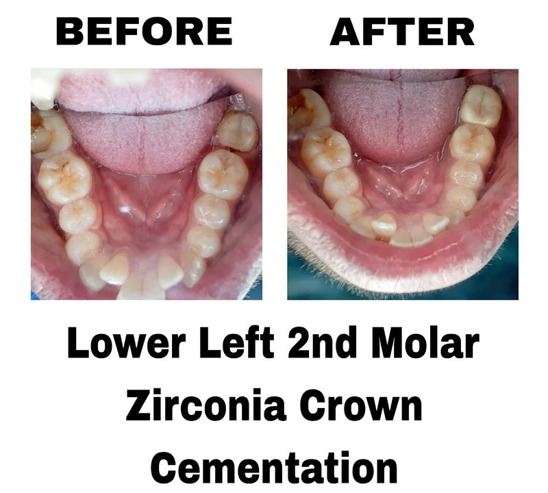 before-and-after-image-of-lower-left-2nd-mollar-zirconia-crown-cementation-at-dentity-dental-tollygunge-suryanagar
