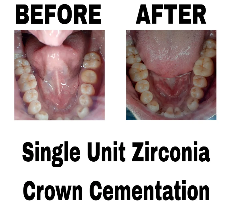 before-and-after-image-of-single-unit-zirconia-crown-cementation-treatment-at-dentity-dental-sonarpur